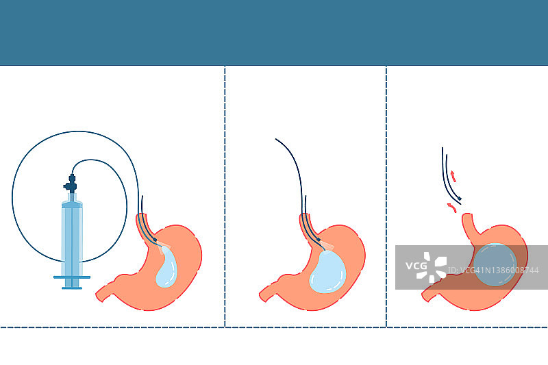 胃球囊概念图图片素材