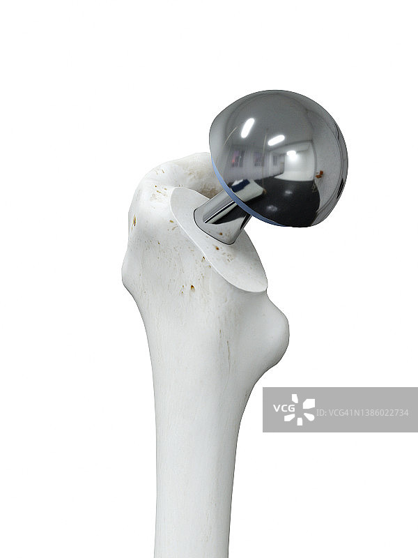 髋关节置换术插图图片素材