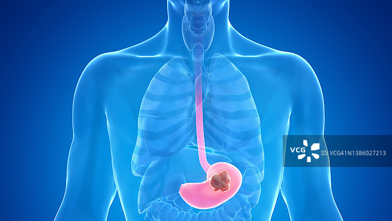 胃癌插图图片素材