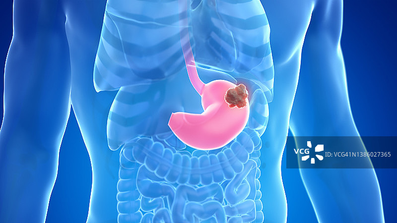 胃癌插图图片素材