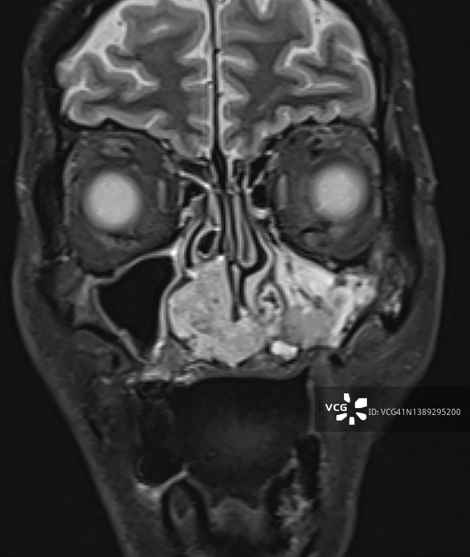 鼻窦肿瘤头部和颈部MRI检查（冠状位）图片素材