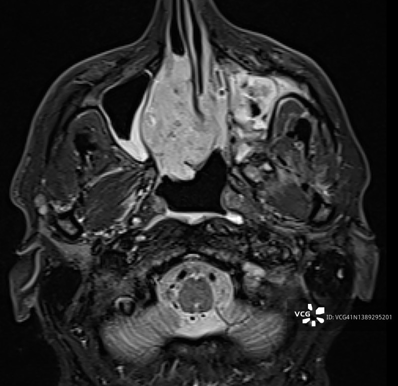 MRI（磁共振成像）轴位显示的鼻窦肿瘤图片素材