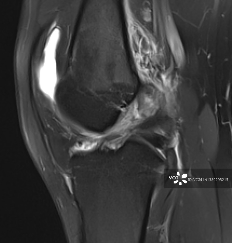 核磁共振成像显示的前交叉韧带完全撕裂图片素材