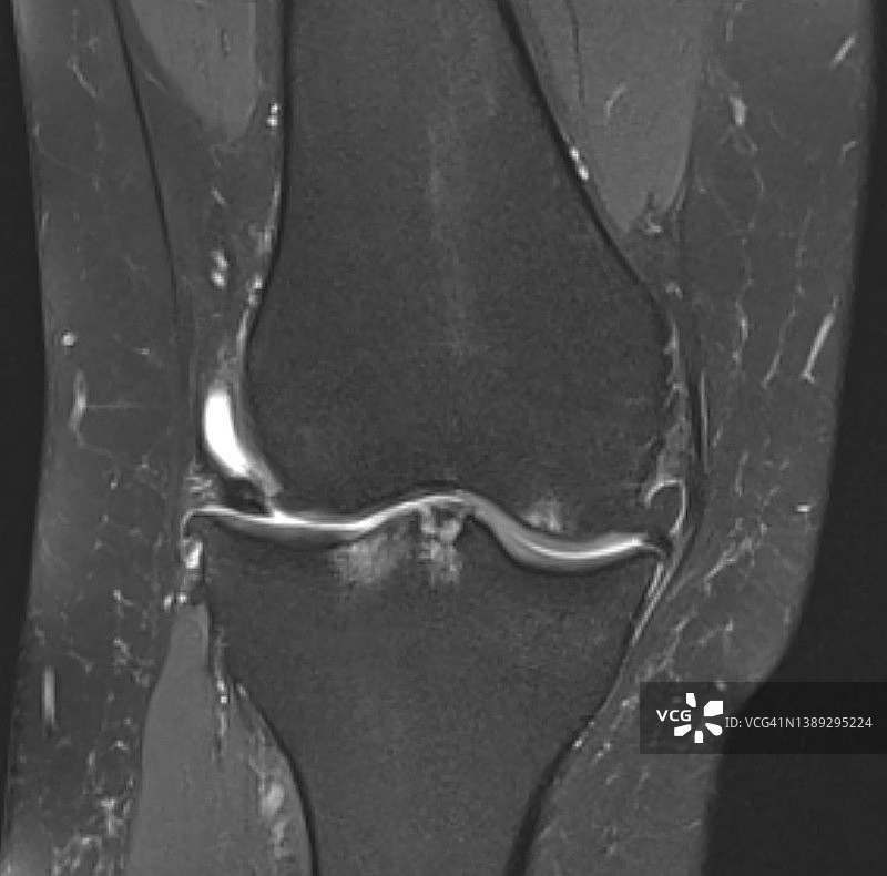 膝关节骨关节炎MRI影像图片素材