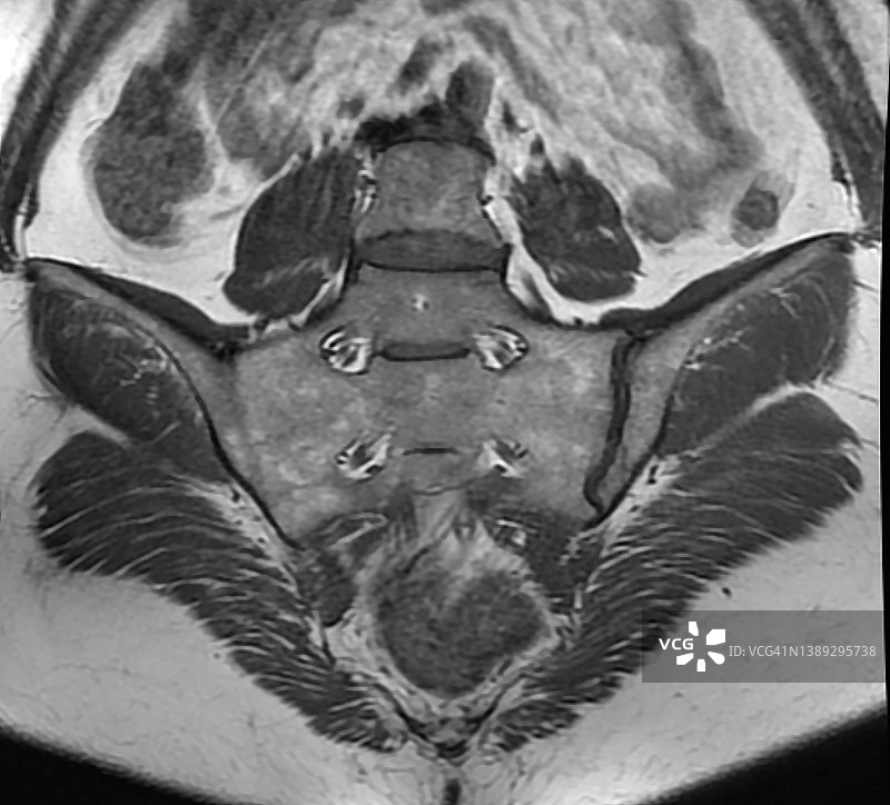 磁共振成像显示的慢性骶髂关节炎右侧关节僵硬（冠状位）图片素材