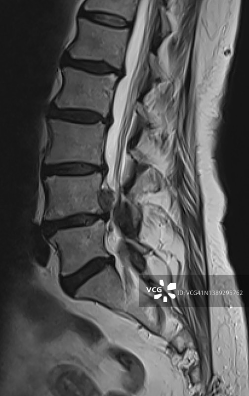 腰椎L4-L5椎间盘突出MRI扫描（矢状位T2）图片素材