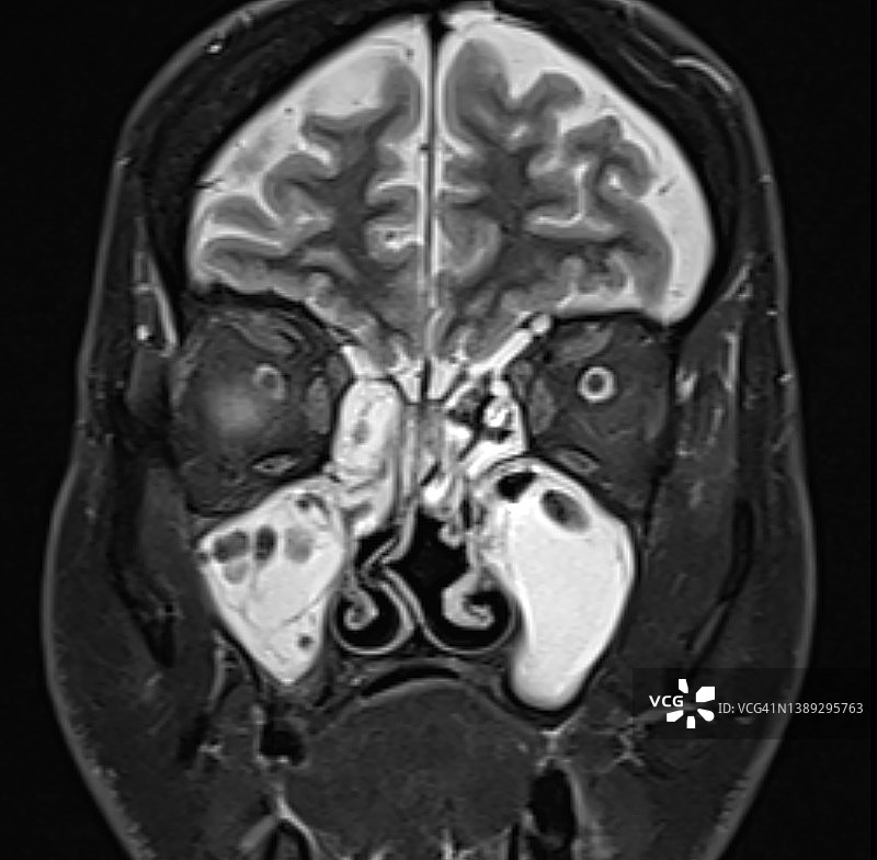 急性鼻窦炎影像：MRI磁共振成像冠状位图片素材