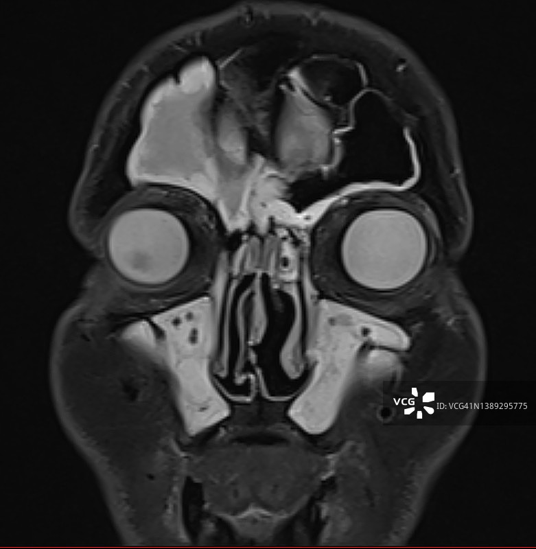 急性鼻窦炎影像：MRI磁共振成像冠状位图片素材