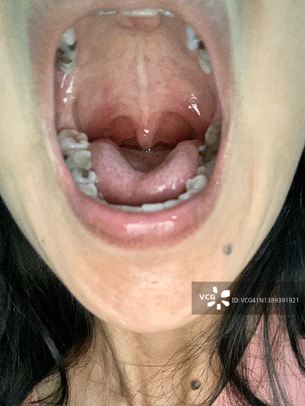 扁桃体炎感染咽喉图片素材