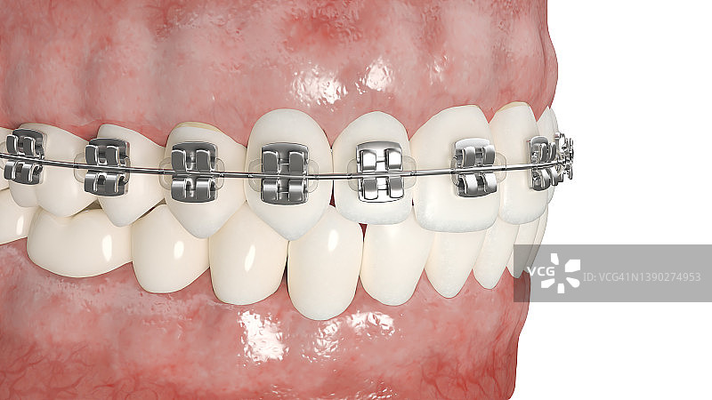 牙科牙套插图图片素材