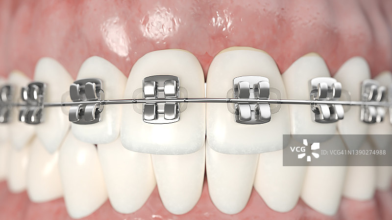 牙科牙套插图图片素材