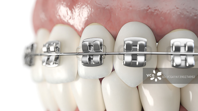 牙科牙套插图图片素材