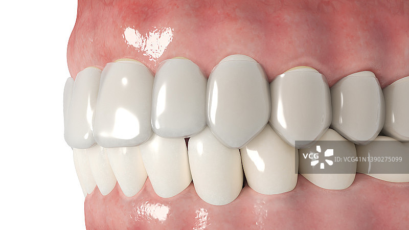 透明牙齿矫正器插图图片素材