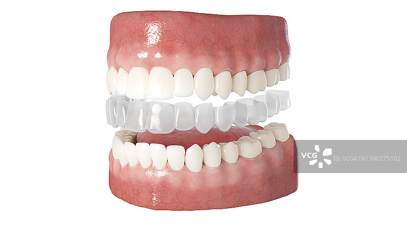 透明牙齿矫正器插图图片素材