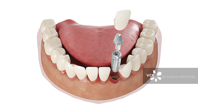 牙科植入体插图图片素材