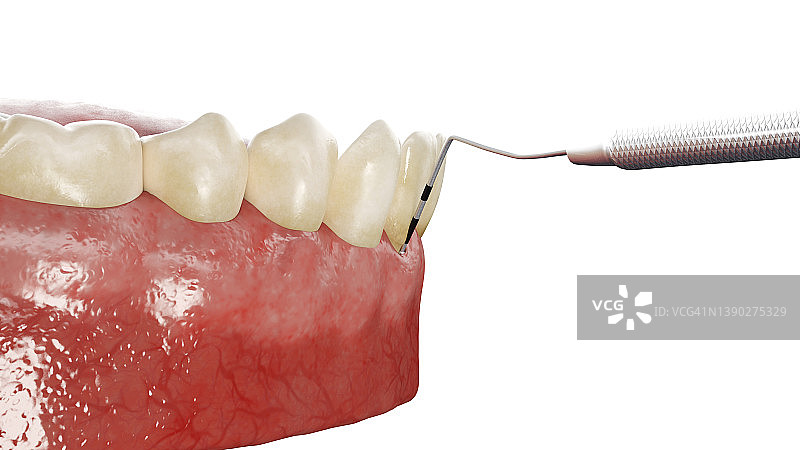 牙周炎测试插图图片素材