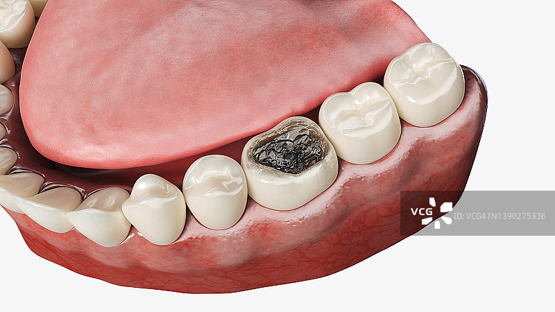 龋齿图示图片素材