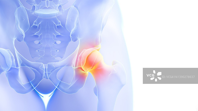 髋关节疼痛插画图片素材