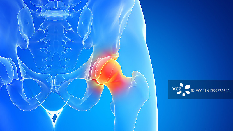 髋关节疼痛插画图片素材