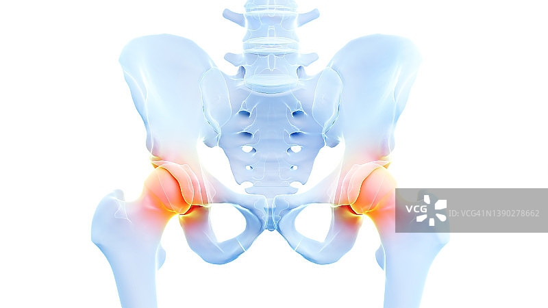 髋关节疼痛插图图片素材