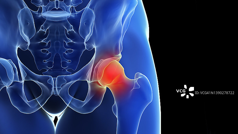 髋关节疼痛插画图片素材