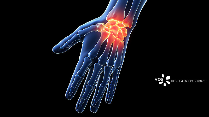 手腕疼痛插画图片素材