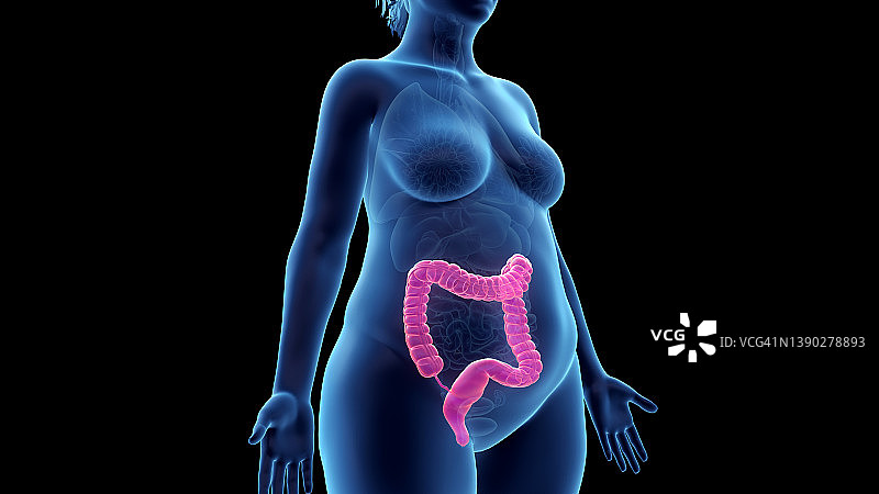 超重妇女的结肠，图示图片素材