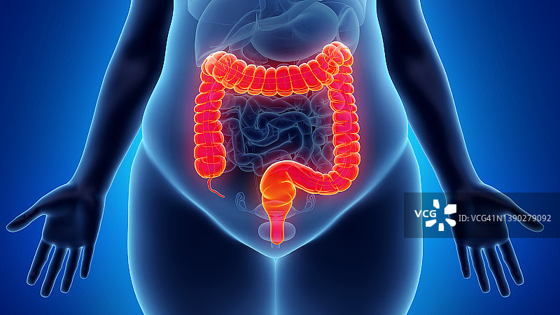 超重妇女的结肠，图示图片素材