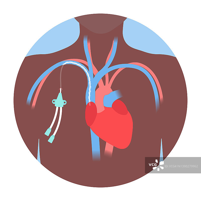 中心静脉导管，图示图片素材