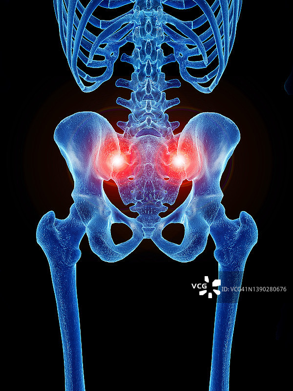 骶髂关节疼痛，图示图片素材