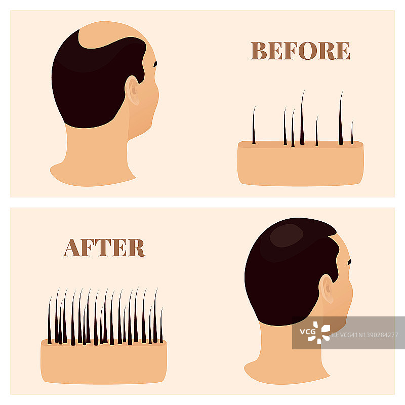 脱发治疗概念插画图片素材