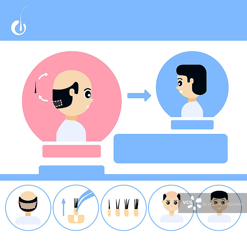 男性FUE头发移植插画图片素材