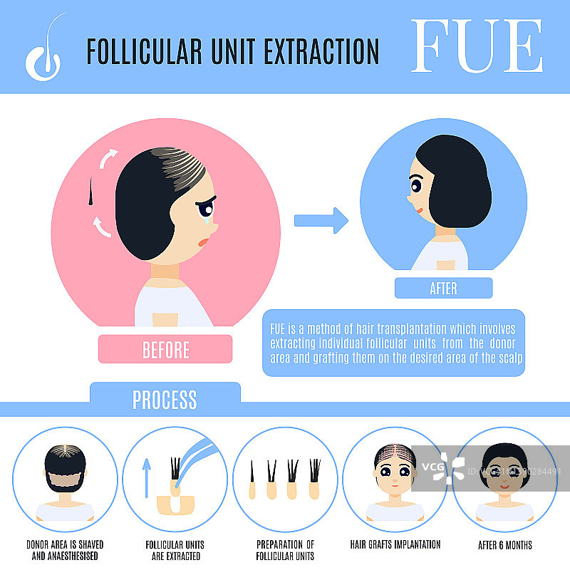 女性FUE毛发移植插图图片素材