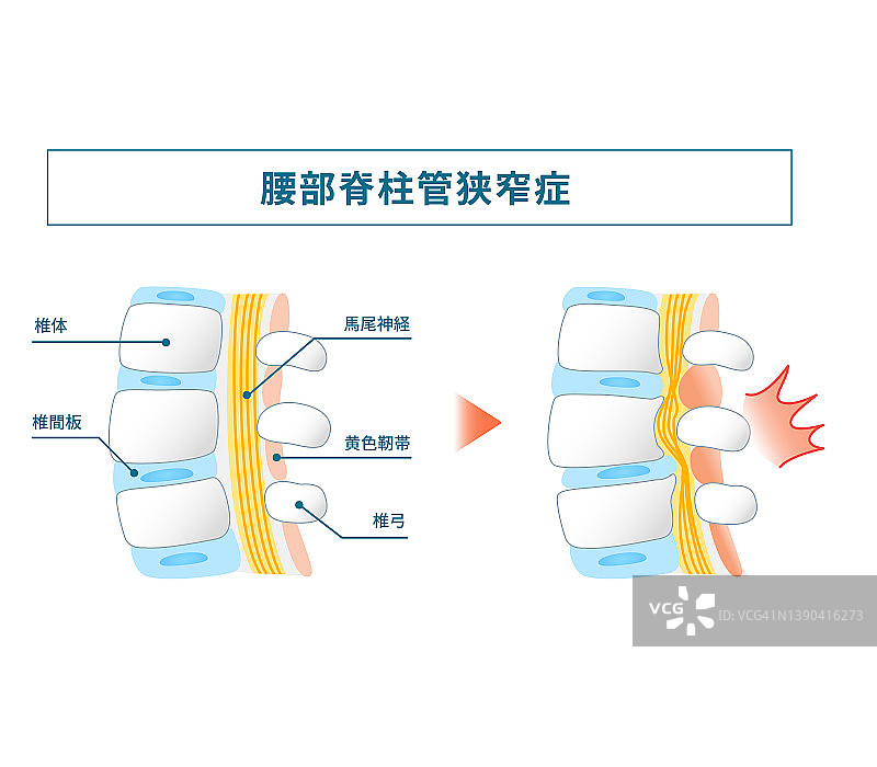 腰椎管狭窄插画图片素材