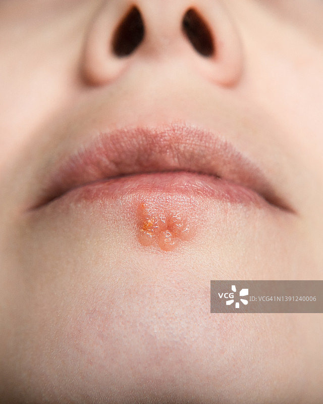 下唇疱疹感染的女人特写照片图片素材