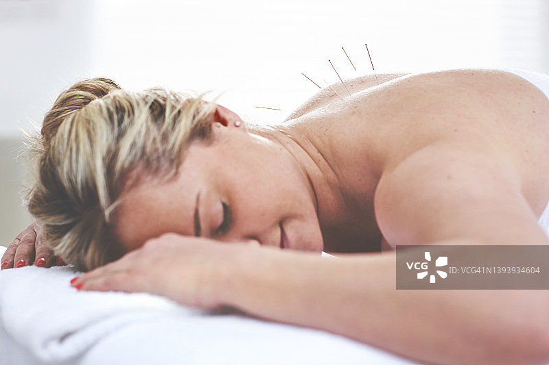 年轻女人在针灸疗程中背部被插入针，患者接受替代疗法图片素材