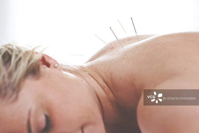 年轻女人在针灸疗程中背部被插入针，患者接受替代疗法图片素材