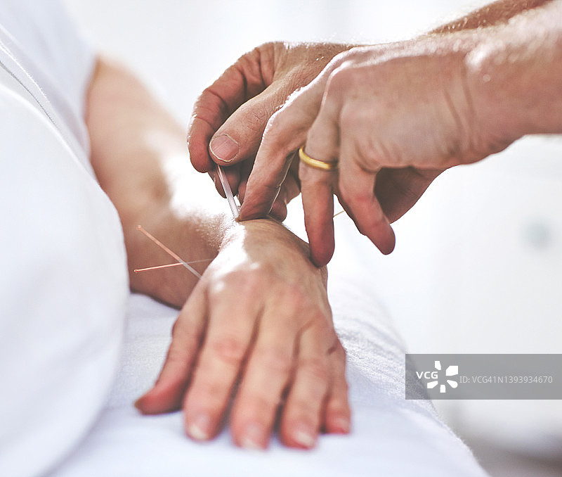 一位身份不明的女性在针灸治疗中，手上被插入针。病人接受替代疗法治疗的特写镜头图片素材