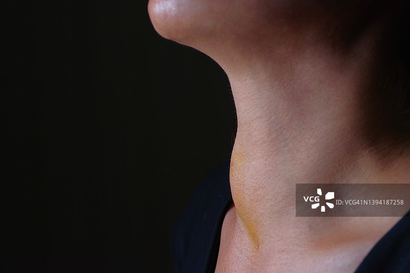 甲状腺结节引起的下咽喉肿胀图片素材