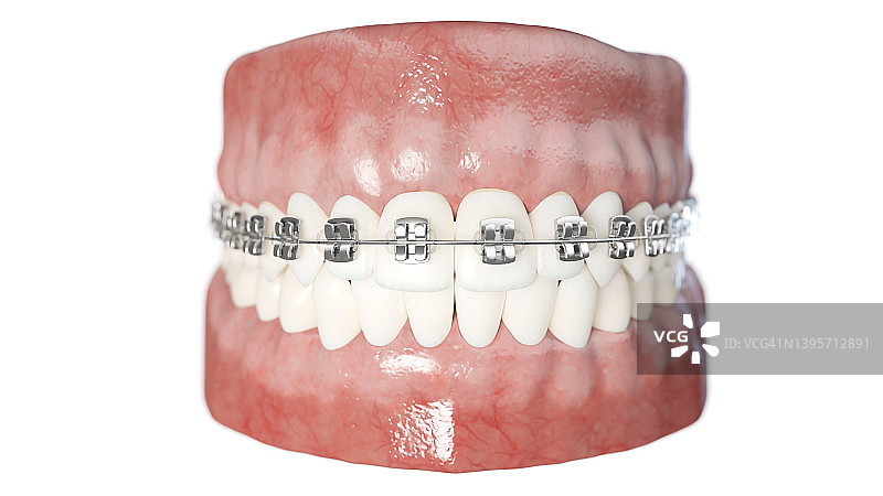 牙科牙套插图图片素材