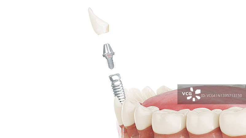 牙科植入体插图图片素材