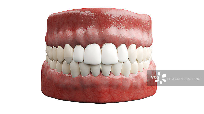 牙科贴面，插图图片素材