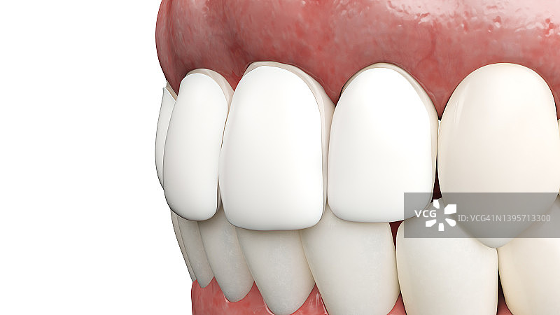 牙科贴面，插图图片素材