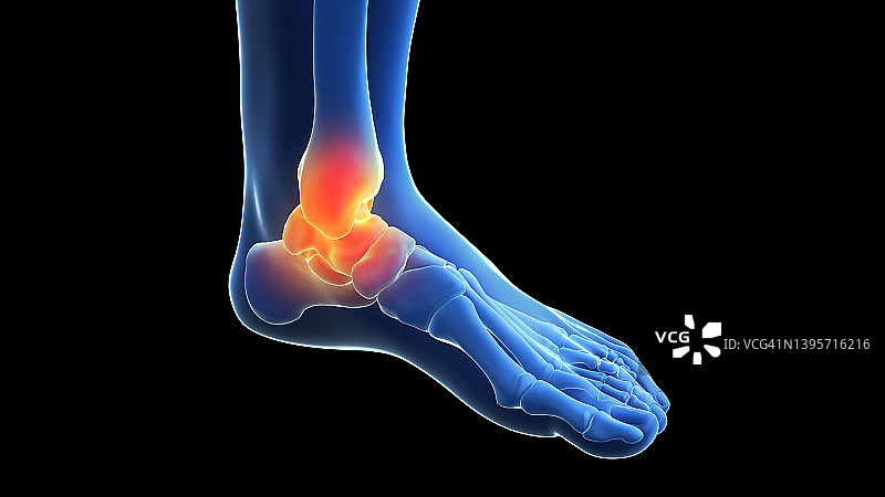 疼痛的踝关节插图图片素材