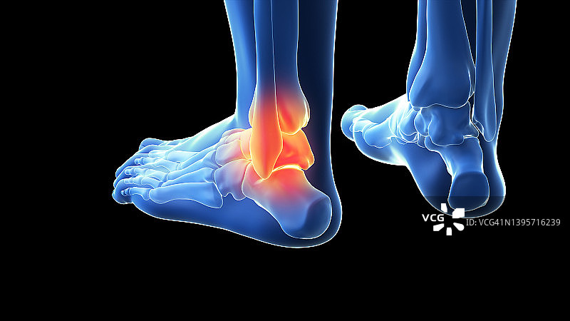 疼痛的踝关节插图图片素材