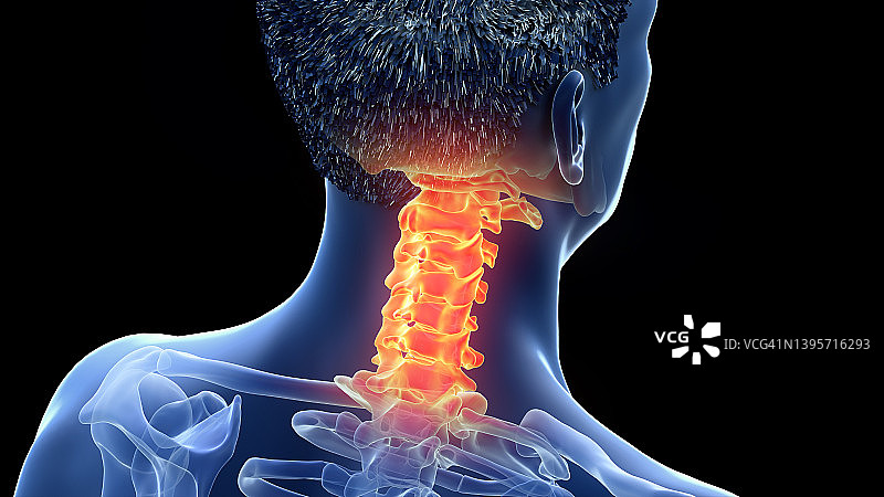 颈椎疼痛插图图片素材