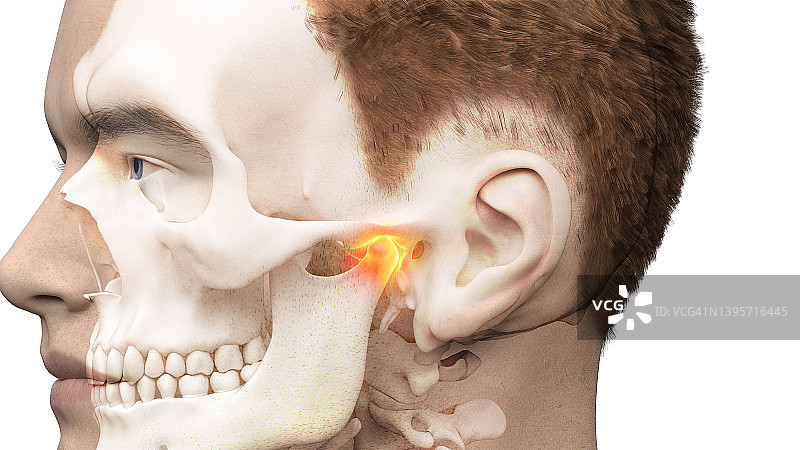 疼痛的颞下颌关节，插图图片素材