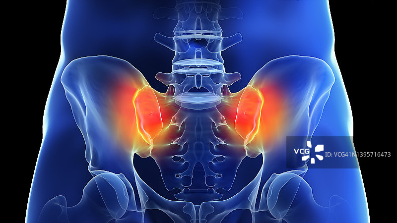 骶髂关节疼痛，图示图片素材