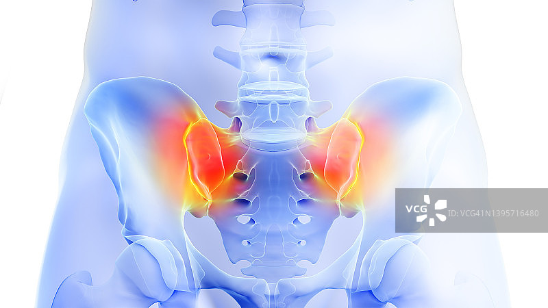 骶髂关节疼痛，图示图片素材