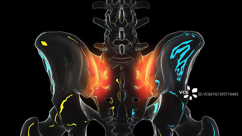 骶髂关节疼痛，图示图片素材
